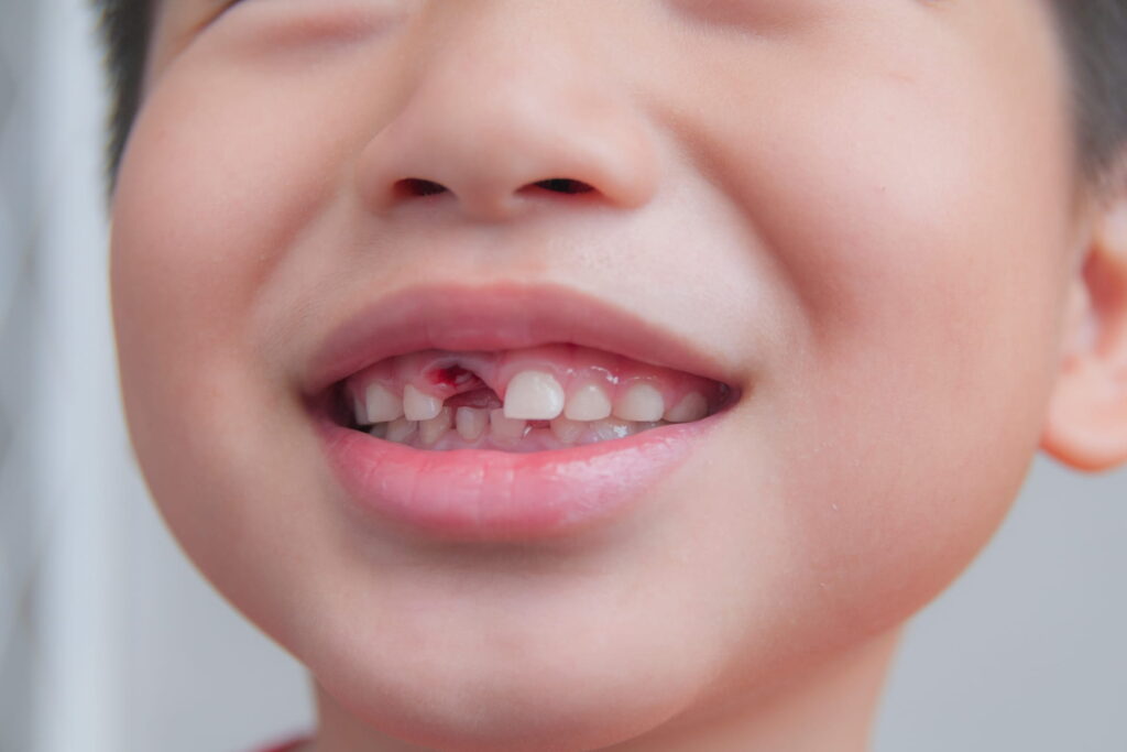 Act Fast! What to Do When Your Child Knocks Out a Tooth
